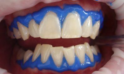 An Honest Review of a Local Dentist Who Specializes in Teeth Whitening