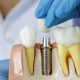 The Ultimate Guide to Dental Implants
